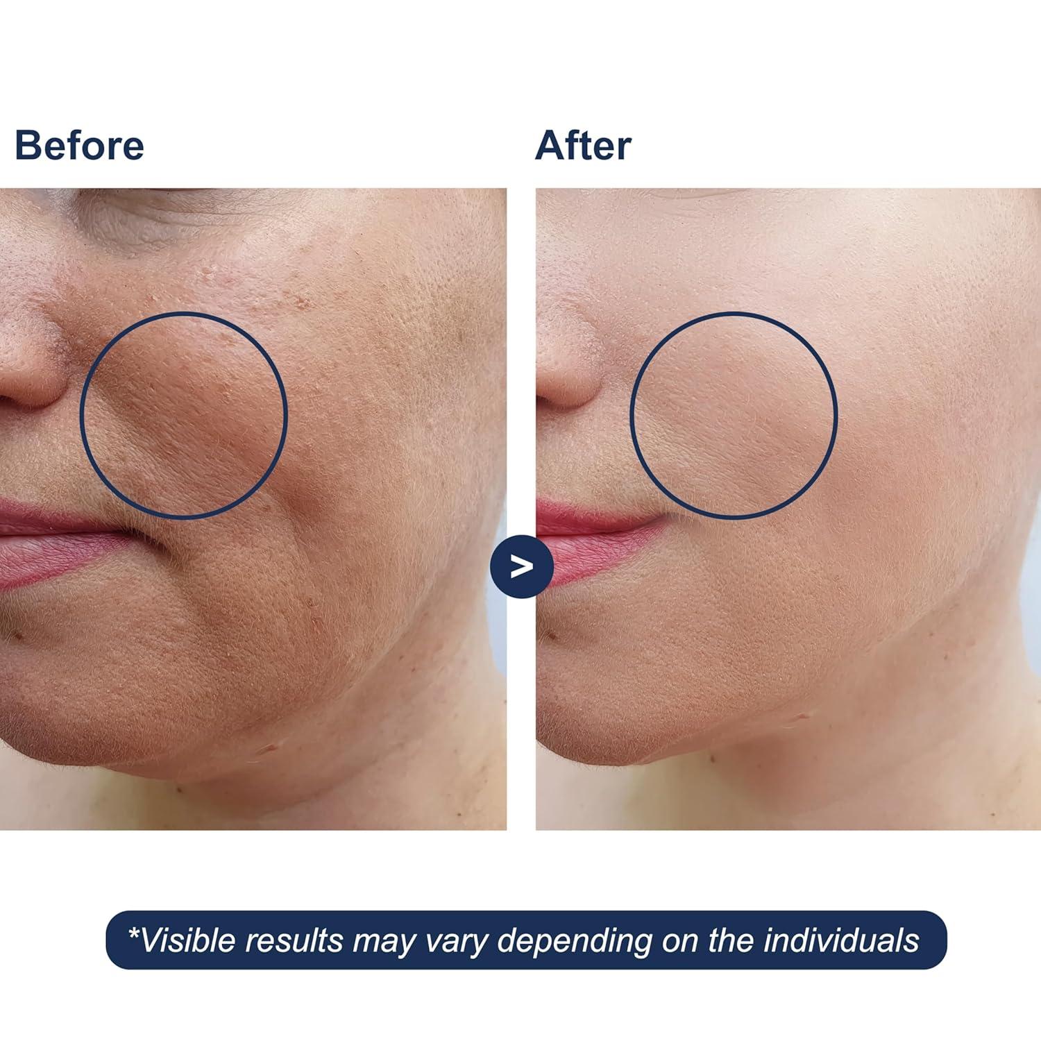 image:imageHyaluronic Acid Serum with Vitamin B5 for Face Lightweight Hydrating Face Serum for Dry amp Sensitive Skin 4 Types of HA at 2 with Vitamin C amp E OilFree amp FragranceFree 4 fl oz
